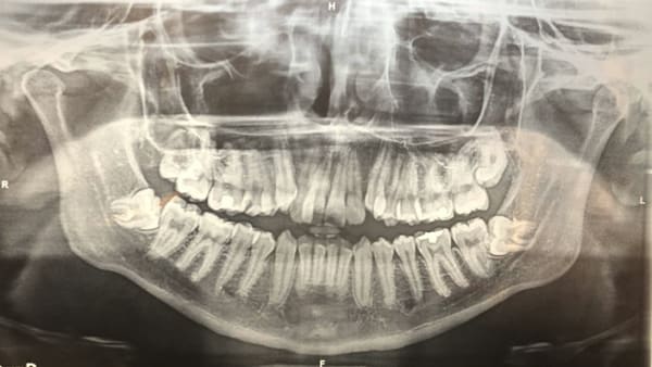 Extraction des dents de sagesse - Clinique Poirier Centre Dentaire