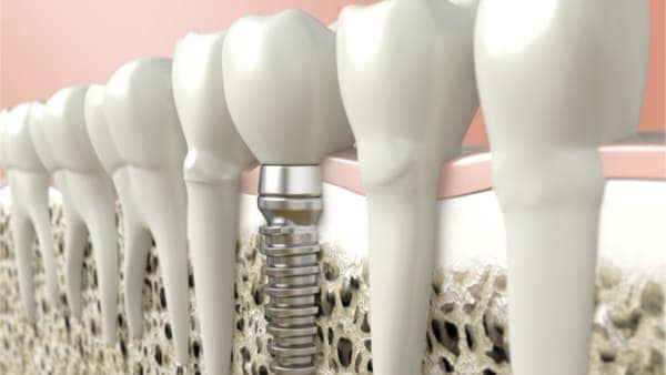 implant dentaire paris implant paris implant dentaire prix docteur flore roul yvonnet chirurgien maxillo facial paris 14