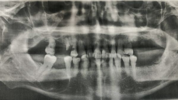 kyste des maxillaires kyste maxillaire kyste des machoires exerese chirurgien maxillo facial paris 14 docteur flore roul yvonnet paris 14