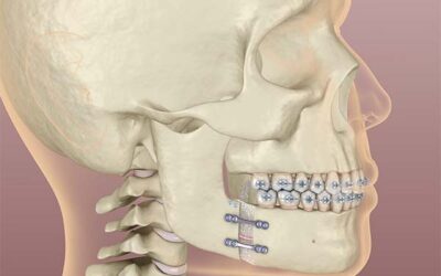 Chirurgie orthognathique : définition & indications