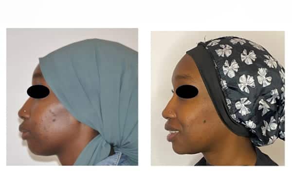osteotomie mandibulaire prix avant apres docteur roul yvonnet chirurgien maxillo facial paris