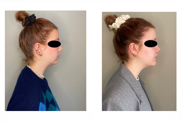 osteotomie mandibulaire prix avant apres dr flore roul yvonnet chirurgien maxillo facial paris