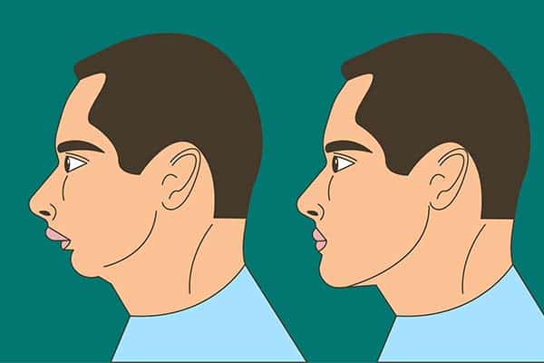 Ostéotomie mandibulaire avant après : quel résultat ?
