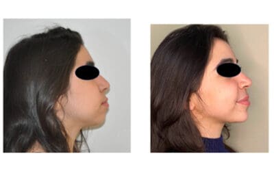 Génioplastie : questions fréquentes