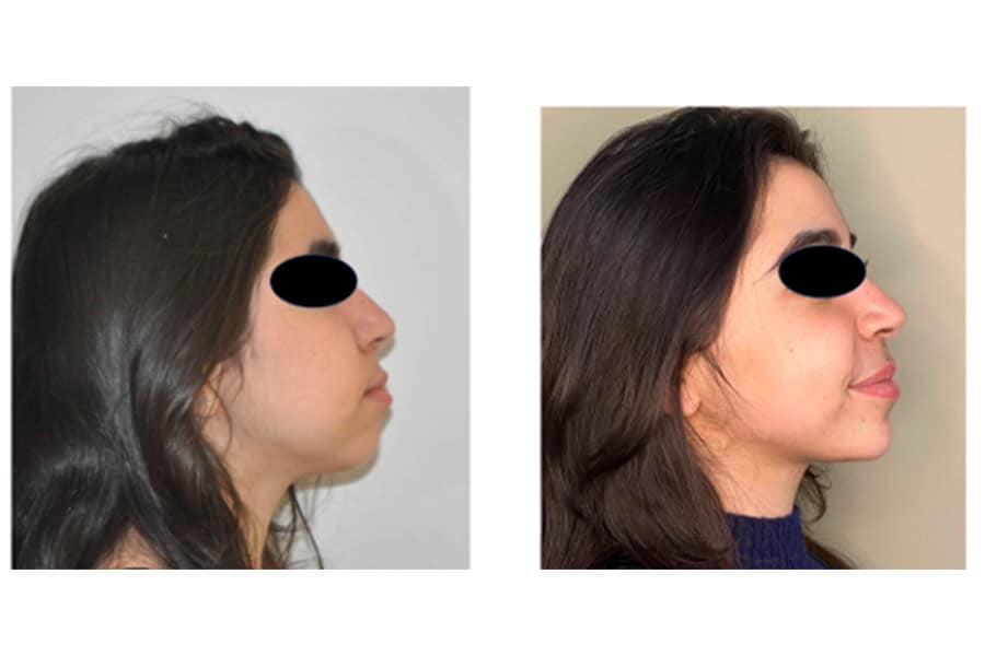 Génioplastie : questions fréquentes