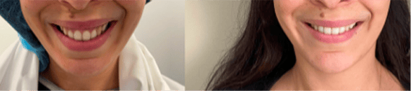 operation sourire gingival solution sans chirurgie gencive avant apres docteur flore roul yvonnet chirurgien maxillo facial paris.jpg