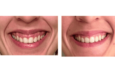 Sourire gingival : quelles solutions en 2025 pour corriger un sourire avec la gencive visible ?