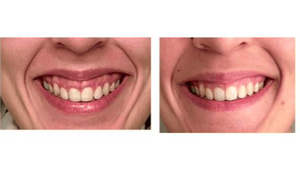 Sourire gingival : quelles solutions en 2025 pour corriger un sourire avec la gencive visible ?